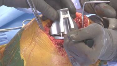 Image from the ATTUNE® Knee Tibial Base Alignment and Coverage with Douglas Dennis, MD and Brian Haas, MD video.