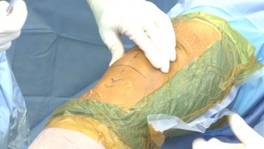 ATTUNE® Cruciate Retaining, RP, Measured Resection Surgery with Joel Politi, MD