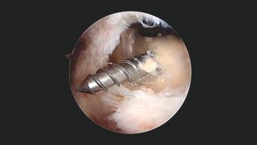 An image of the "Subscapularis Repair Featuring the EXPRESSEW® III Autocapture+ Flexible Suture Passer (Shoulder Arthroscopy)" video.