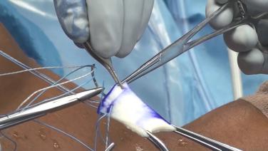An image of the "Superior Capsule Reconstruction with Paul Favorito, MD" video on the JnJInstitute.com website.