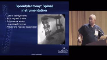 An image of the "Techniques for Complete Spondylectomy of the Thoracolumbar Spine with Curtis Dickman, MD" video.