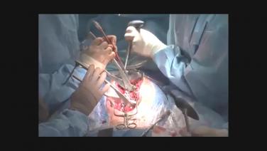 Dr. Hutchinson performs Scoliosis Correction with EXPEDIUM® Favored Angle Screw System