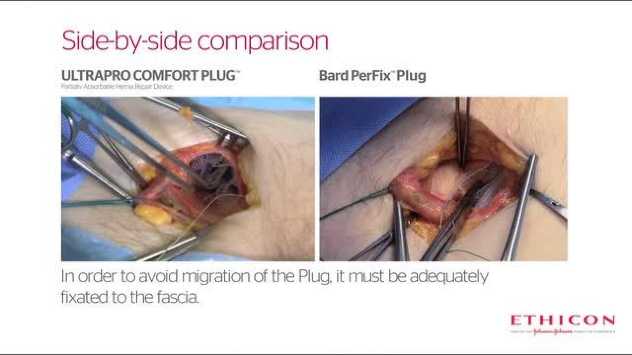 An image of the "ULTRAPRO COMFORT PLUG™ Partially Absorbable Hernia Repair Device Comparison" video.
