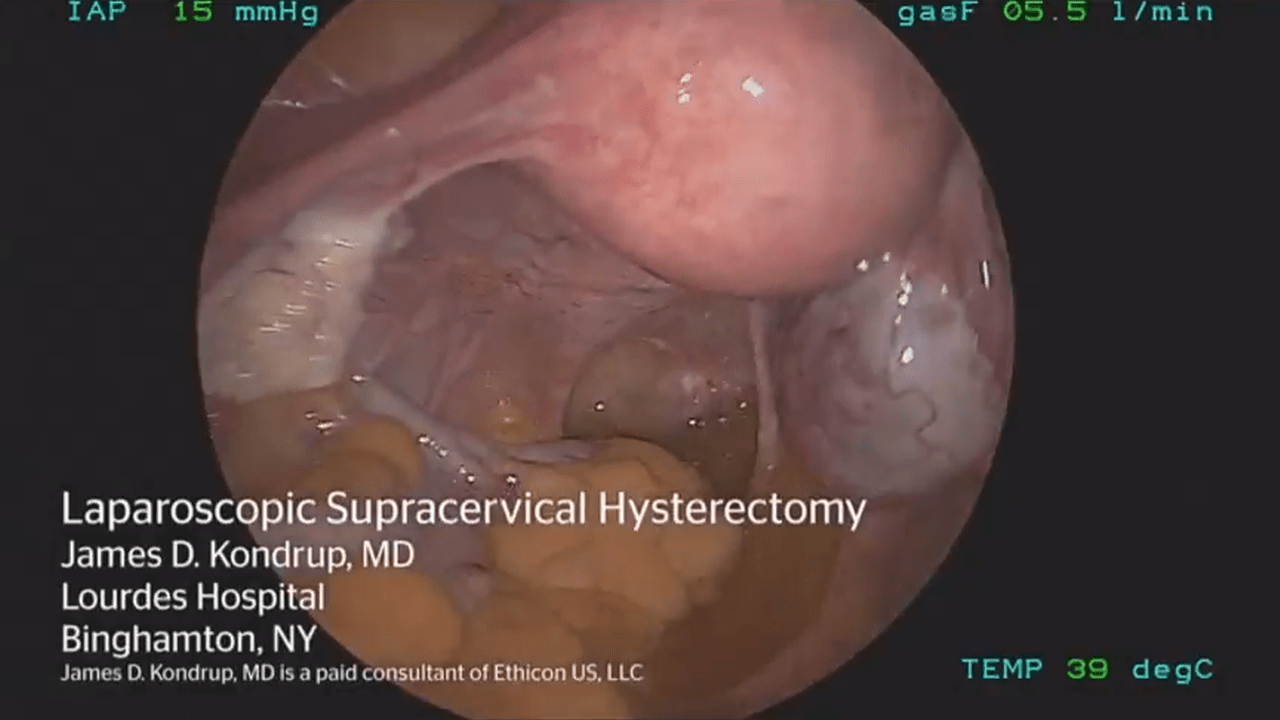 An image of the "Laparoscopic Supracervical Hysterectomy using HARMONIC ACE+ with James Kondrup, MD" video on the JnJInstitute.com website.