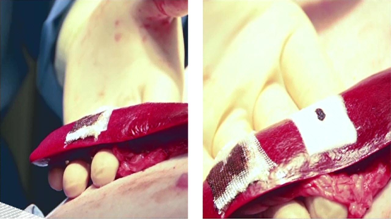 An image from the "SURGICEL® FIBRILLAR™ vs SURGICEL® Original Hemostatic Efficacy Study" video on the JnJInstitute.com website.
