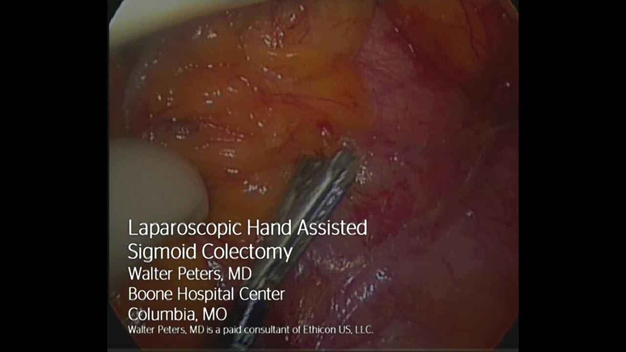 Laparoscopic Hand Assisted Sigmoid Resection by Walter ...