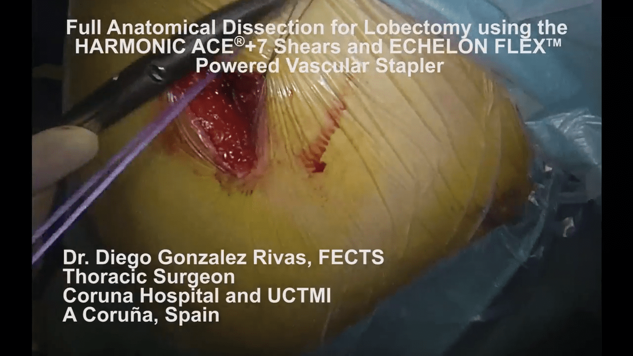 An image from the "Full Anatomical Dissection for Lobectomy using the HARMONIC ACE® +7 Shears & ECHELON FLEX™ Powered Vascular Stapler with Diego Gonzalez Rivas, MD" video on the JnJInstitute.com website.