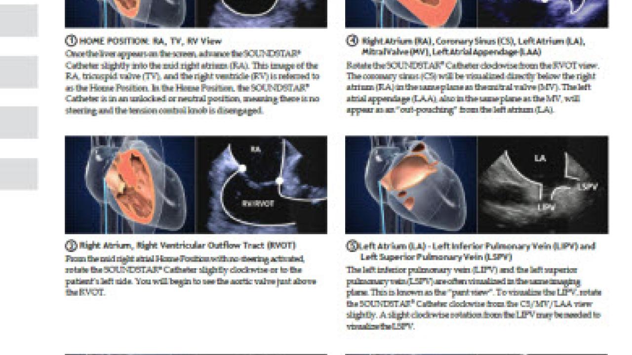 An image from the "ICE Catheter Imaging Manipulation Guide" document on the JnJInstitute.com website.