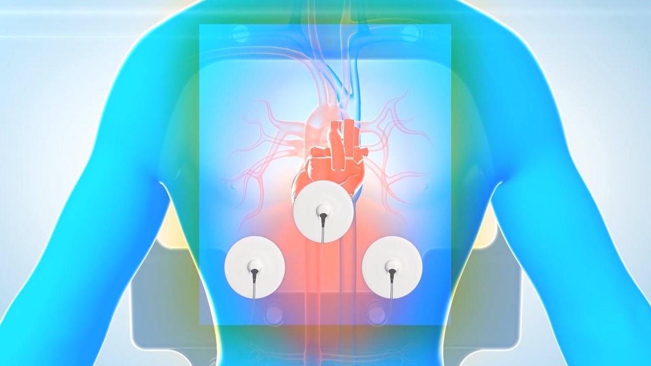 image of "CARTO® 3 System Patch Placement" video on jnjinstitute.com