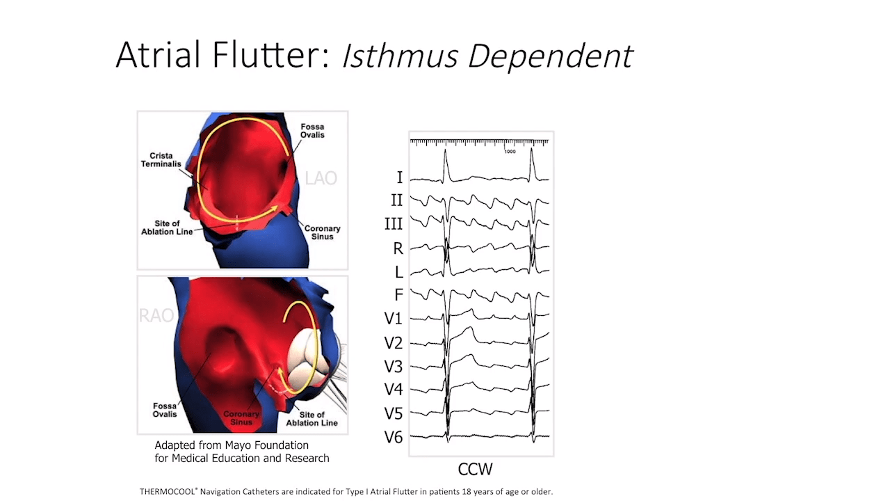 An image from the "Typical Atrial Flutter with Melvin Scheinman, MD" video on JnJInstitute.com website.