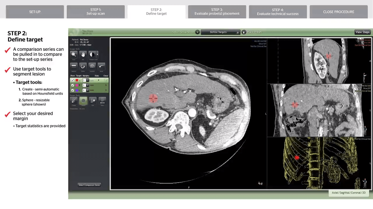An image from the "NeuWave™ Ablation Confirmation™ Software" video on the JnJInstitute.com website.