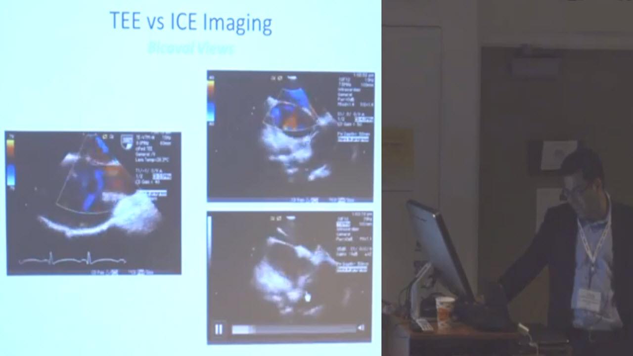 An image of the "Imaging to Guide ASD & PFO Closures with Jamil Aboulhosn, MD" video.