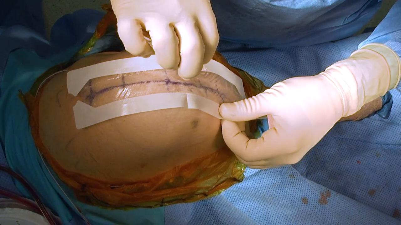 An image from the "DERMABOND® PRINEO® Total Knee Replacement Surgery - Wound Drainage with James Dowd, MD" video on the JnJInstitute.com website.