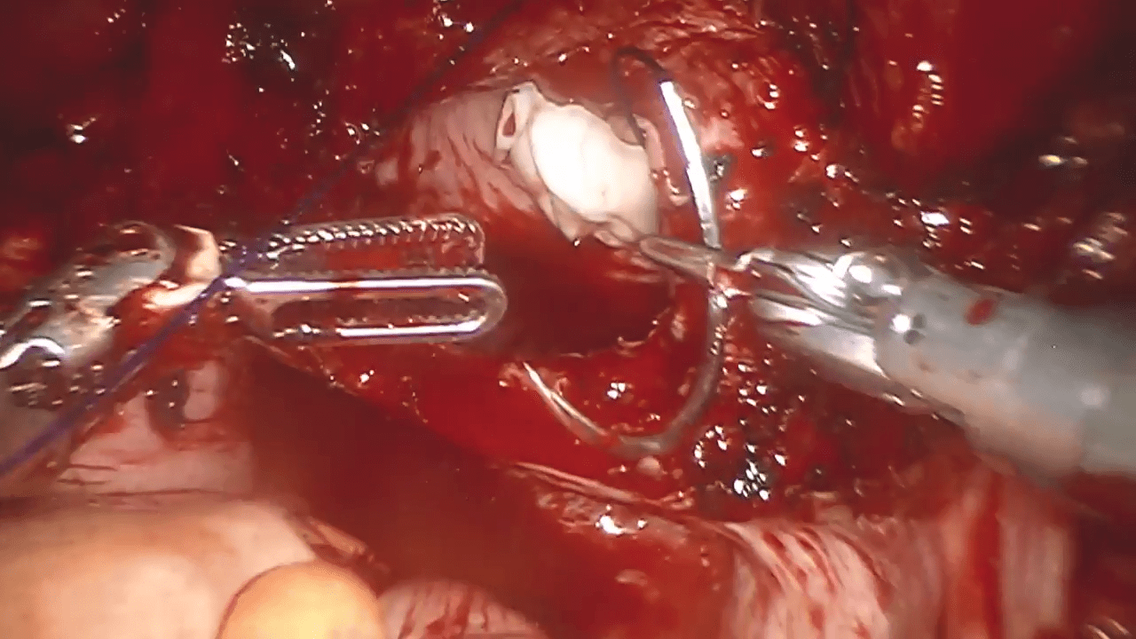 An image from the "Initiating Robotic Vaginal Cuff Closure with STRATAFIX Spiral PDS Plus by Dwight Im, MD" video on the JnJInstitute.com website.