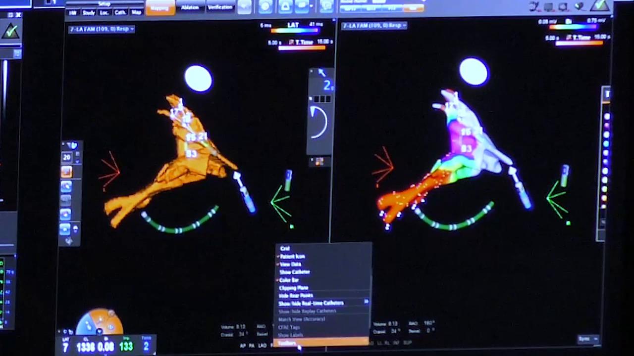 An image of the "Mapping During the AF Procedure with Brett Gidney, MD" video on the JnJInstitute.com website.