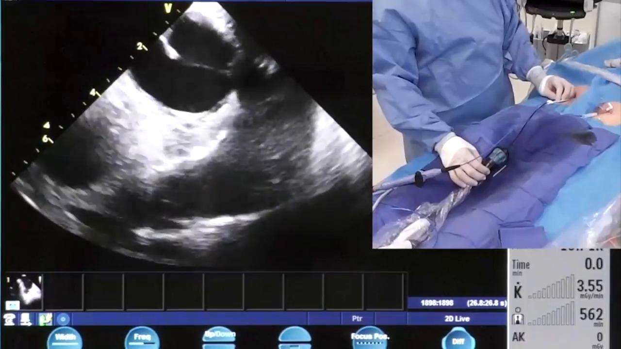 An image of the "In the EP Lab - ICE & Mapping During the PVC Case with Andrew Brenyo, MD" video on the JnJInstitute.com website.