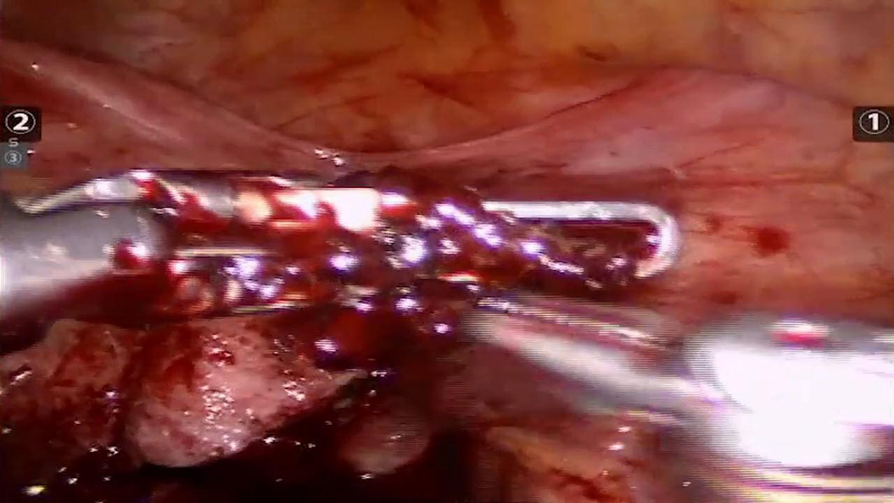 An image of the "STRATAFIX™ Spiral PDS™ Plus Knotless Tissue Control Device in a Robotic Myomectomy" video.