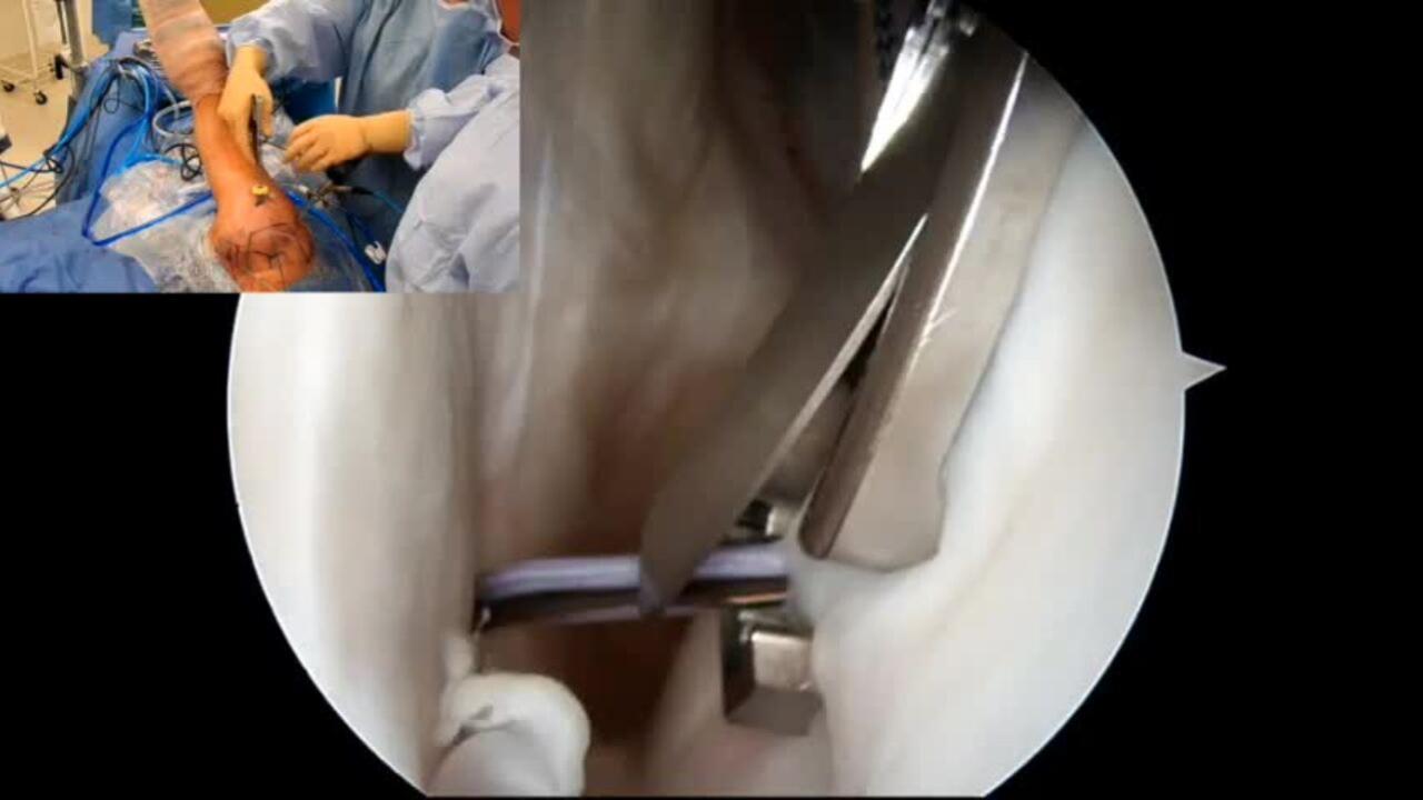image of "Rotator Cuff Repair using HEALIX ADVANCE ACHORS AND HEALIX ADVANCE Knotless Anchors" video on jnjinstitute.com