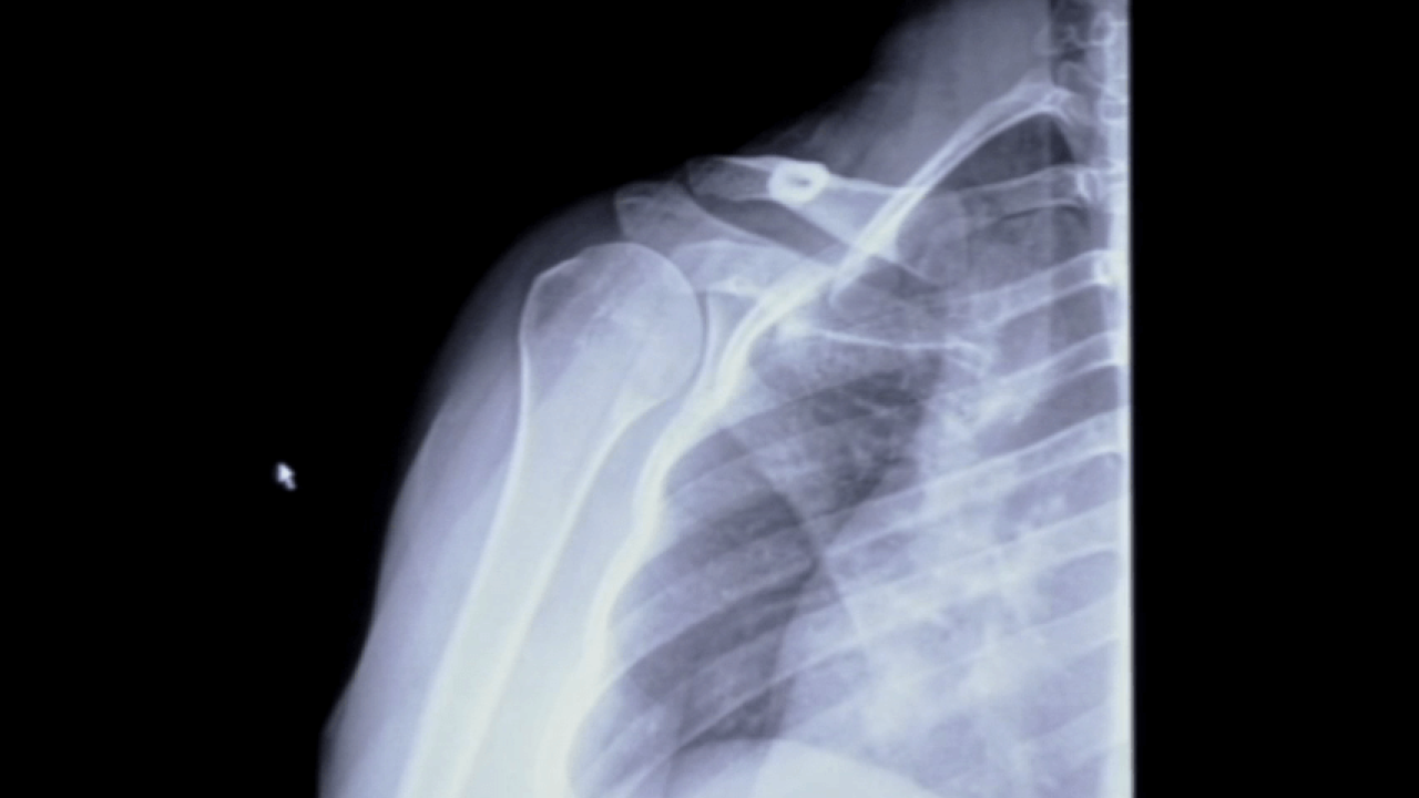 MRI & Xray Review Labral Tear Shoulder with Stephanie Muh, MD thumbnail