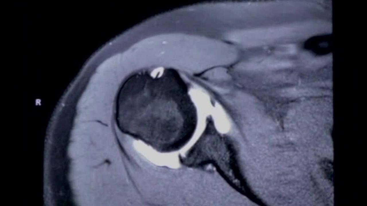 image of "MRI & Xray Review Labral Tear Shoulder" video on jnjinstitute.com