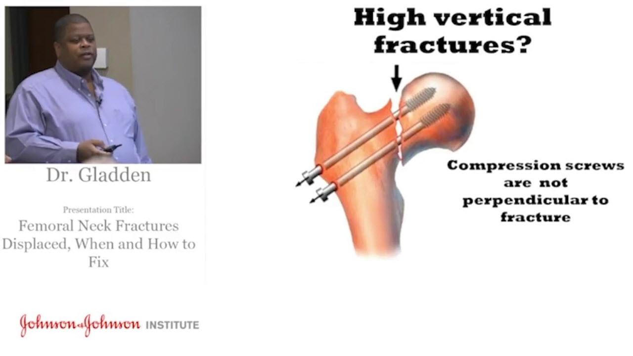 image of Femoral Neck Fractures with Paul Gladden, MD video on jnjinstitute.com