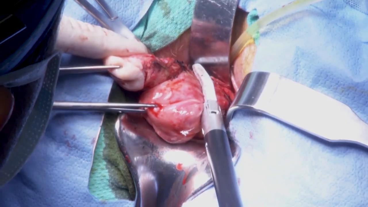 An image from the "Total Vaginal Hysterectomy using the ENSEAL® X1 Large Jaw with Steven McCarus, MD" video on the JnJInstitute.com website.
