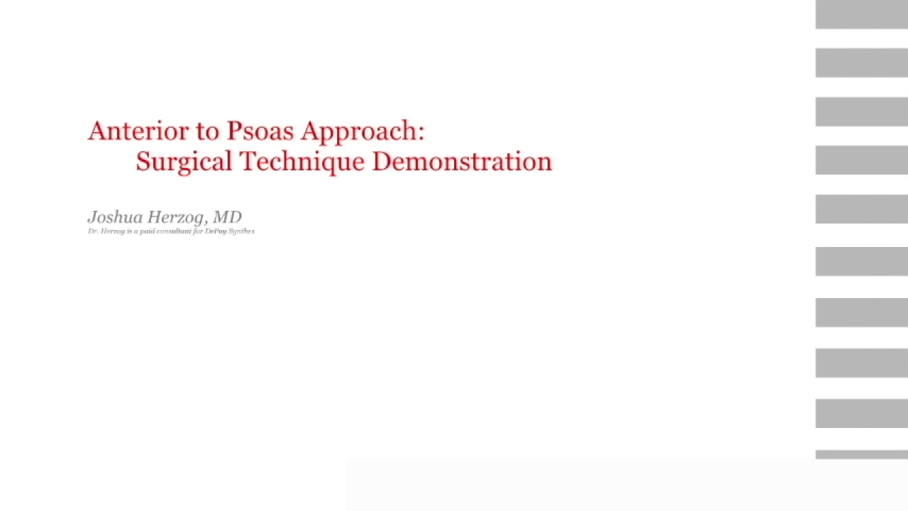 An image from the "Anterior to the Psoas Surgical Demonstration with Joshua Herzog, MD" video on the JnJInstitute.com website.
