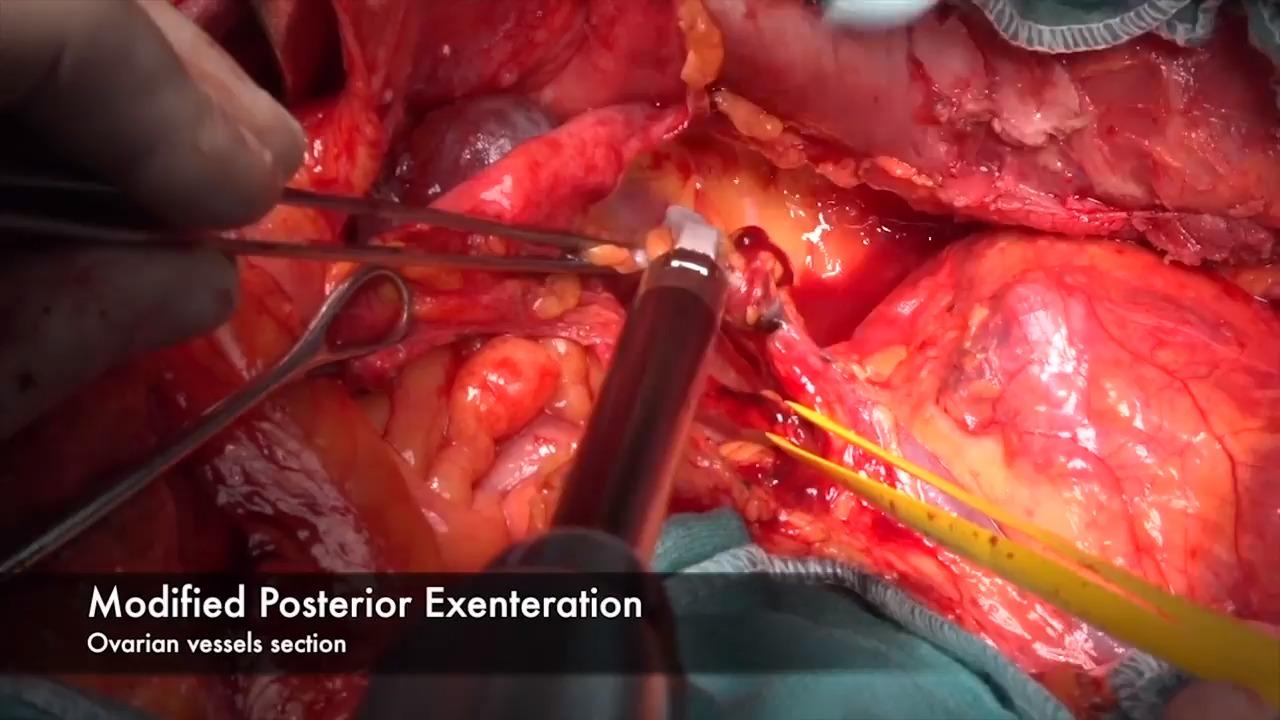 Image from: "Modified Posterior Exenteration" on the jnjinstitute.com website
