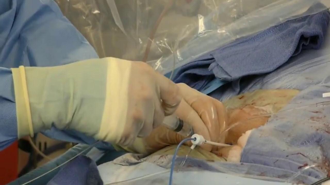 An image of the "Transseptal Puncture Techniques with G. Joseph Gallinghouse, MD" video.