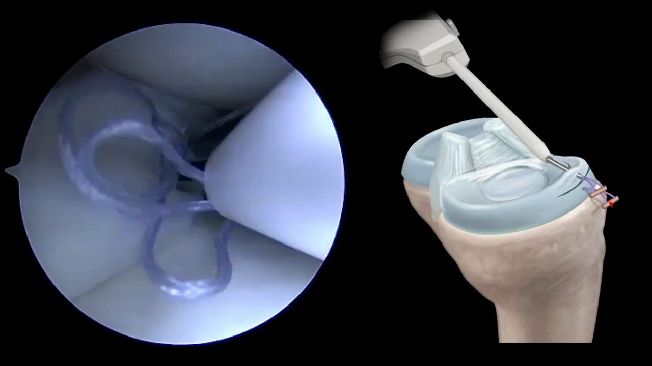 An image of the "Anterior Meniscal Repair Video using TRUESPAN™ Meniscal Repair System with Tony Nguyen, MD" video on the JnJInstitute,com website.