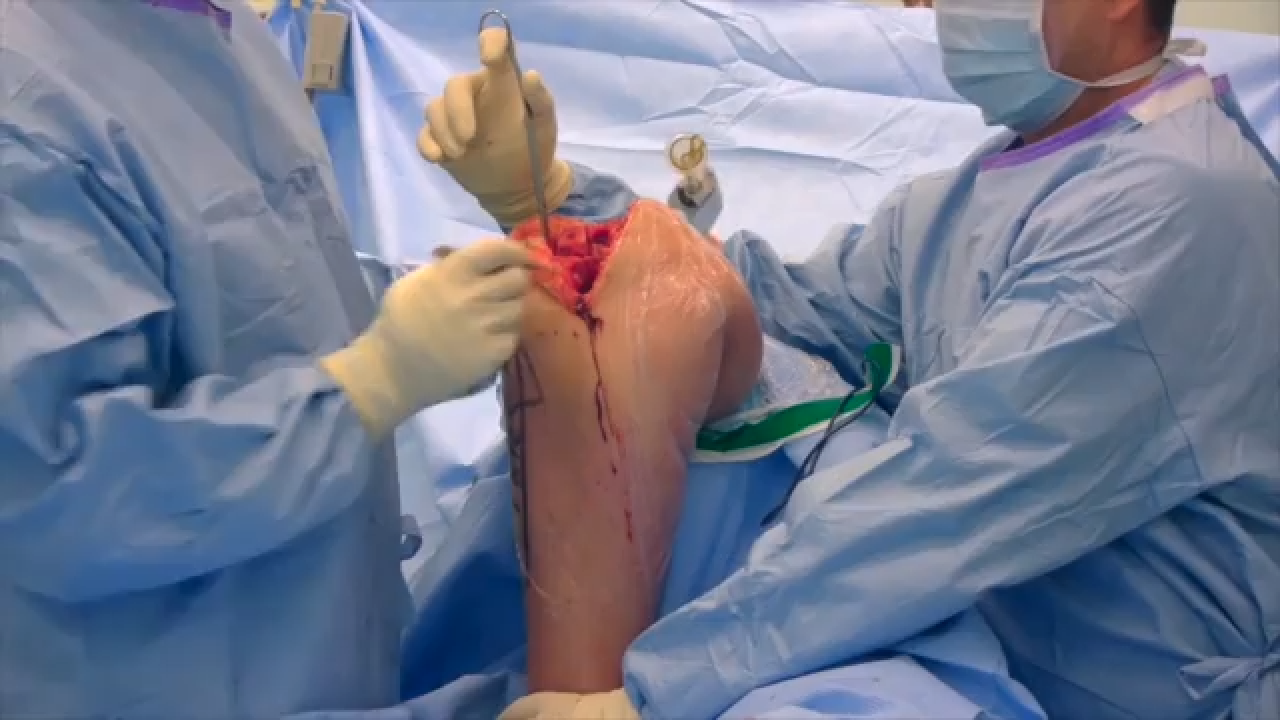 Total Knee Replacement Cementing Technique featuring Professor David