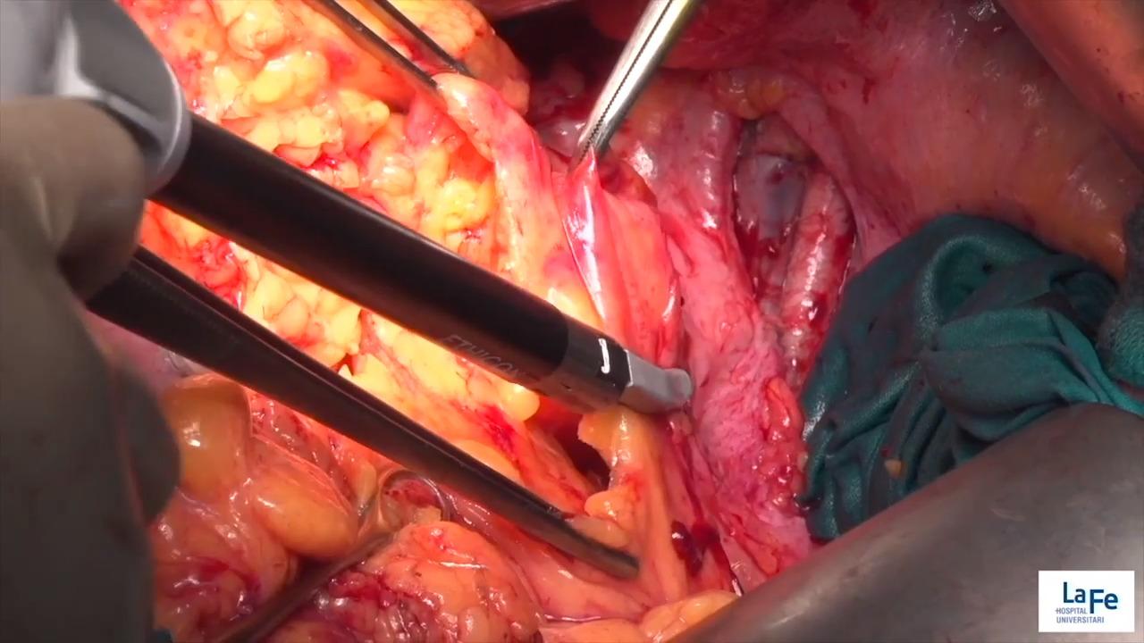 Image from: "Total Pelvic Exenteration" on the jnjinstitute.com website