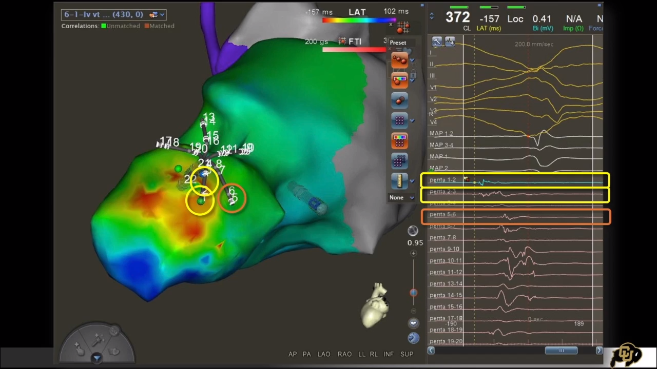 An image of the "VT Ablation - From Concepts to Case with Wendy Tzou, MD, FHRS, FACC" video on the JnJInstitute.com website.