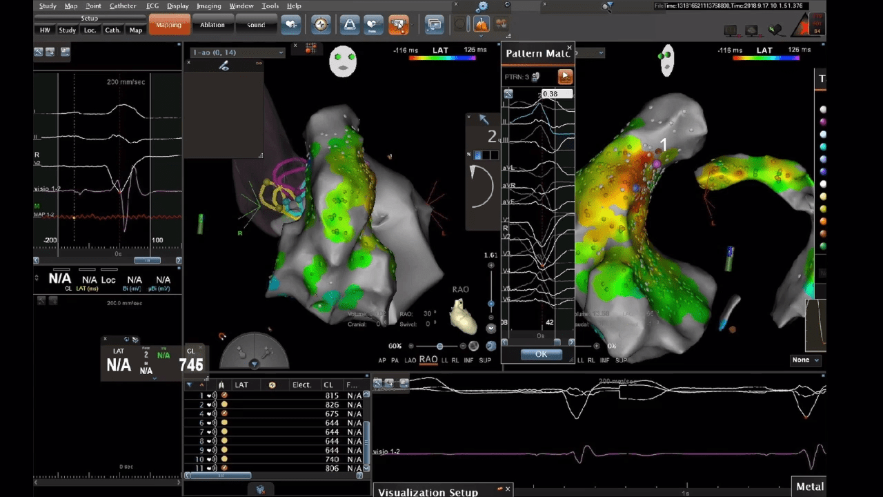 An image of the "LV Summit PVC Case Study Presentation with Albert Y. Sun, MD" video on the JnJInstitute.com website.