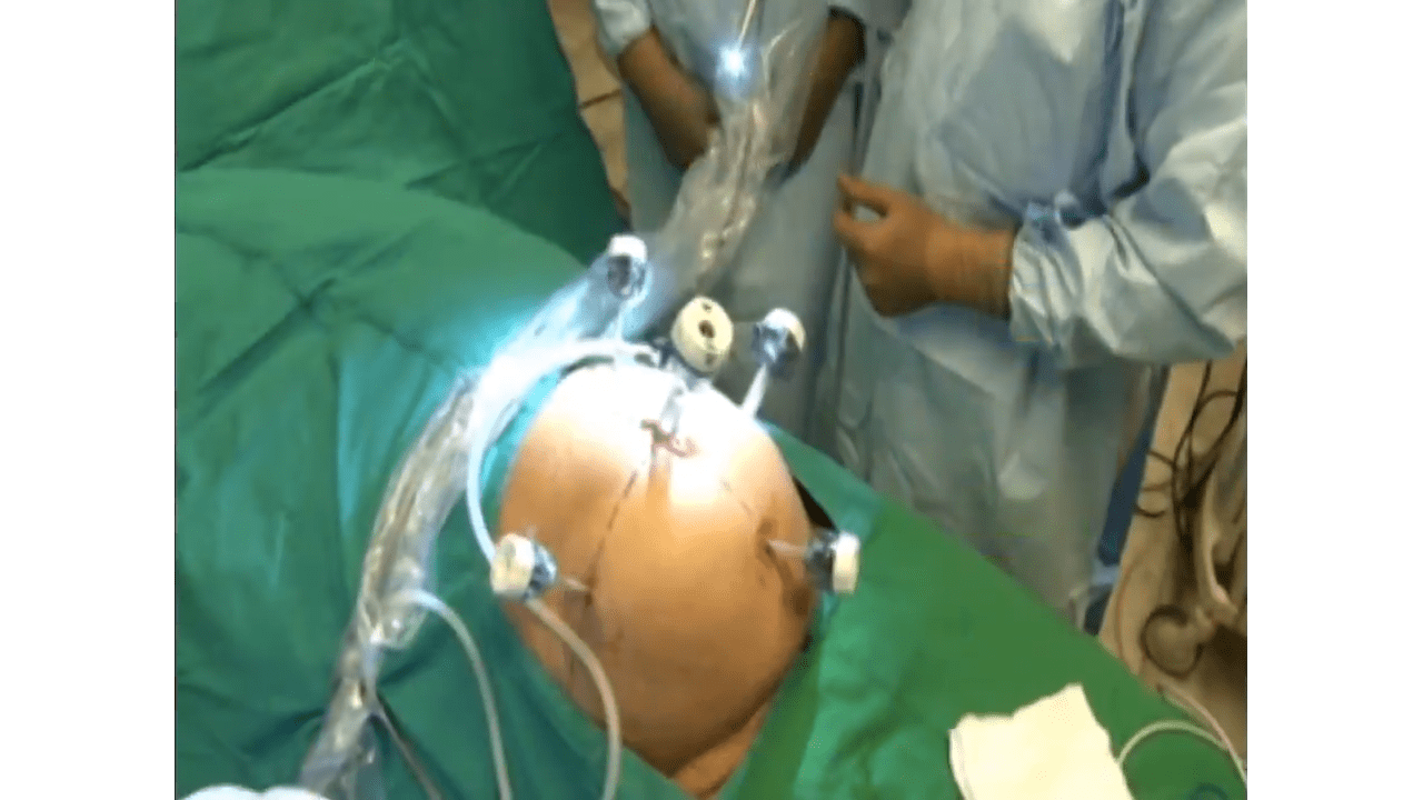 Laparoscopic Right Extended Hemicolectomy And A Complete Mesocolic Excision Johnson And Johnson 2322
