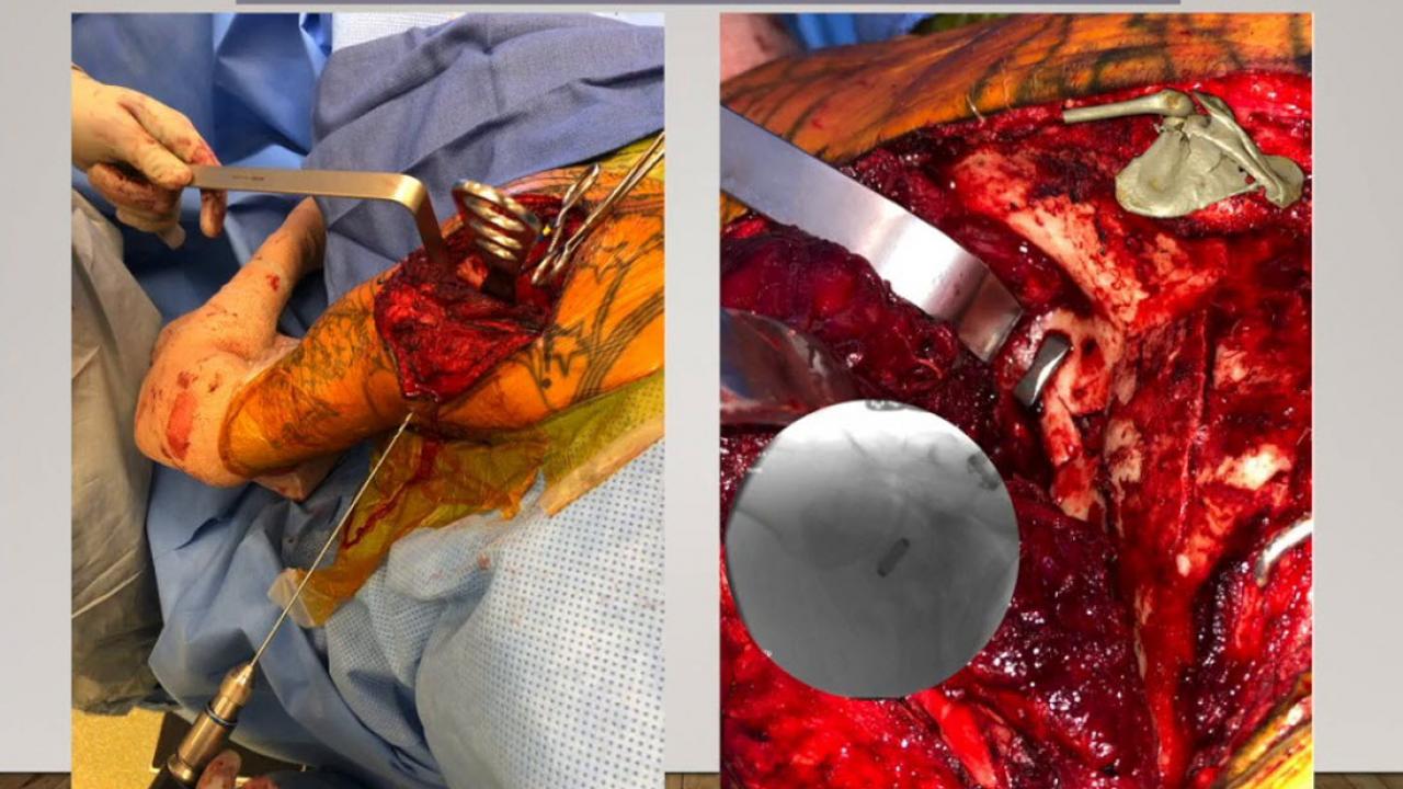 An image from the "NITINOL Continuous Compression Implants with Kevin Grant, MD" video on the JnJInstitute.com website.