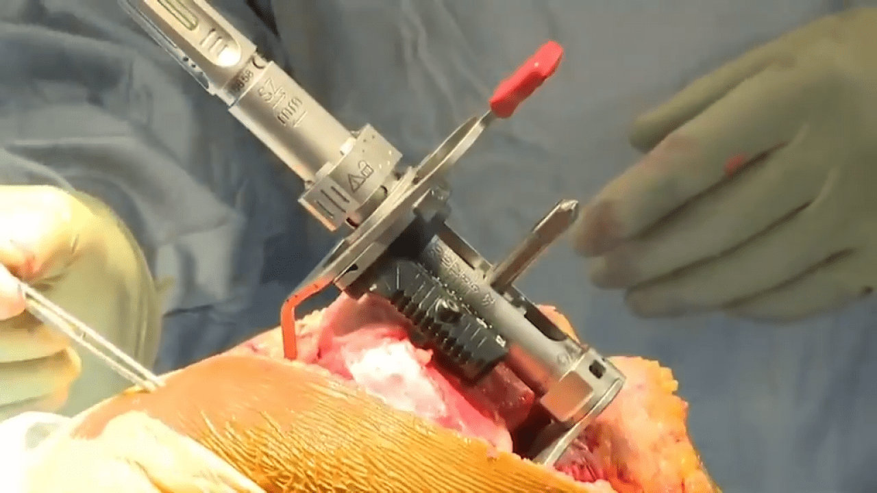 An image of the "ATTUNE® Knee System Cruciate Sacrificing, Rotating Platform, Balanced Resection Surgery with Peter James, MD" video on the JnJInstitute.com website.