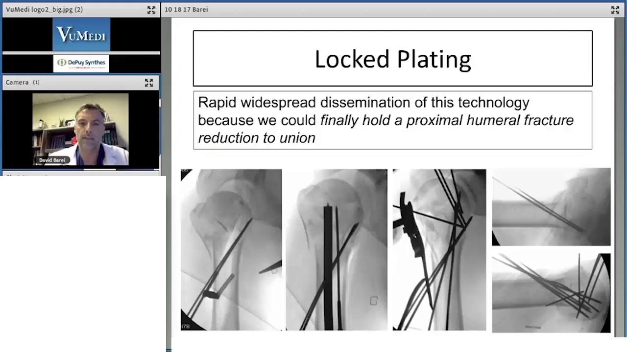 Proximal Humerus Fractures - Controversies, Plate, Nail or Replace with David Barei, MD