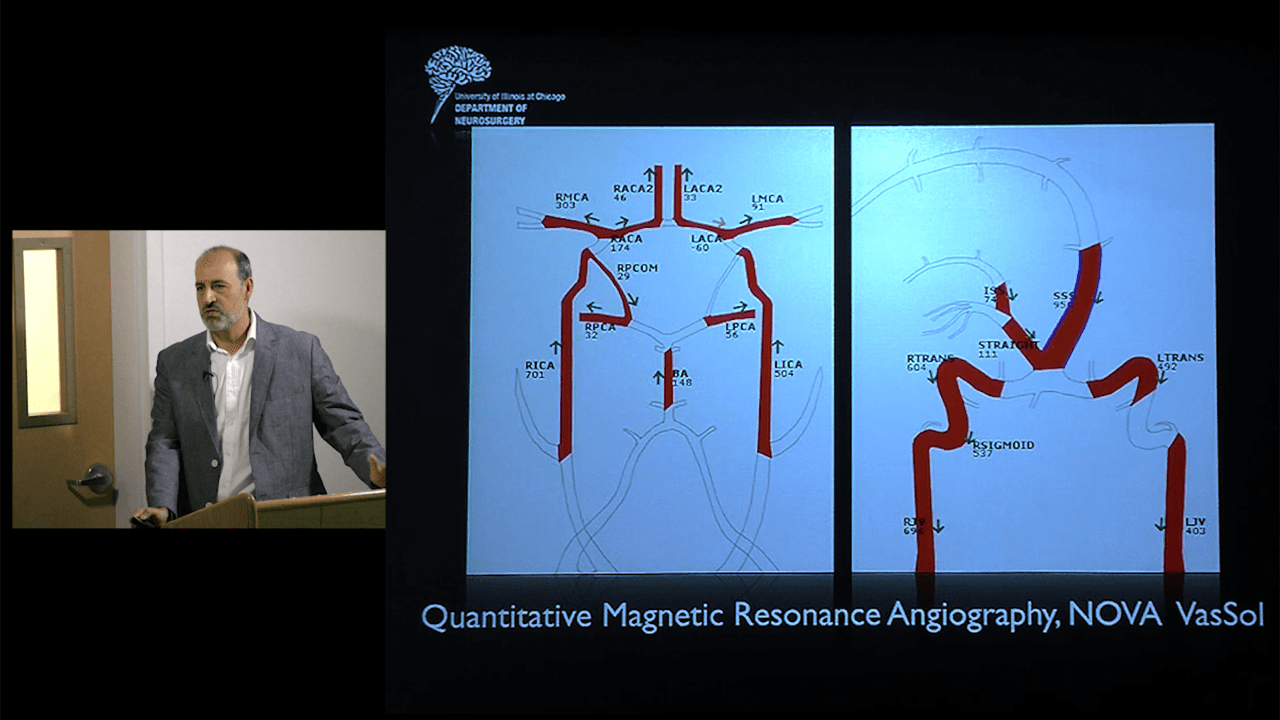 An image of the "The Role of Embolization in Treatment of AVM - Ali Alaraj, MD" video.