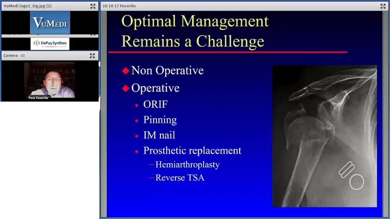 An image from the "Proximal Humerus Fractures: Reverse Shoulder Arthroplasty with Paul Favorito, MD" video on the JnJInstitute.com website.