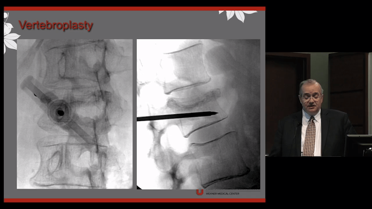 Vertebroplasty & Kyphoplasty in Spinal Tumors with Eric Bourekas, MD