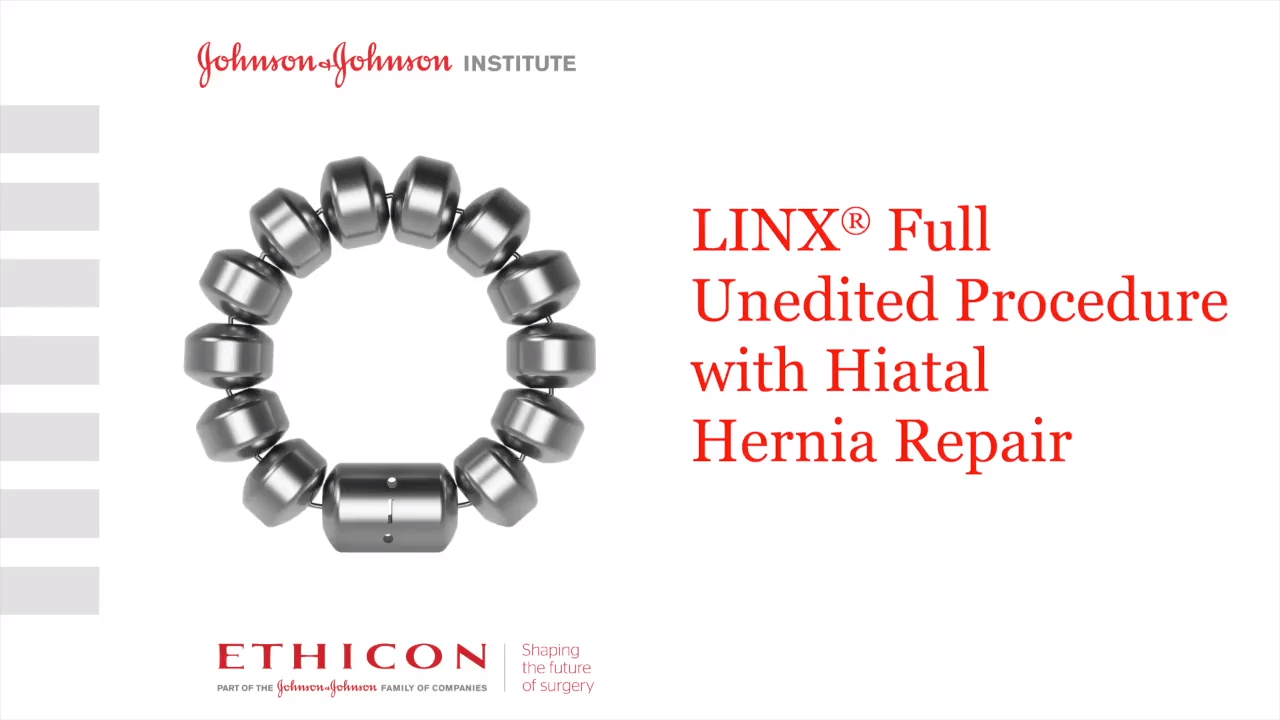 LINX® Full Uneditied Procedure with Hiatal Hernia Repair