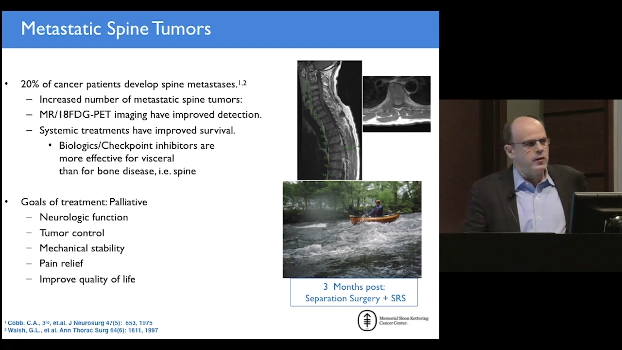 An image from the "METS Compression: NOMS to SINS with Mark Bilsky, MD" video on the JnJInstitute.com website.