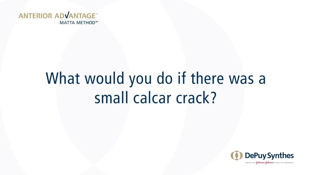 ANTERIOR ADVANTAGE™ Discussion with Joel Matta, MD - What would you do if there was a small calcar crack?