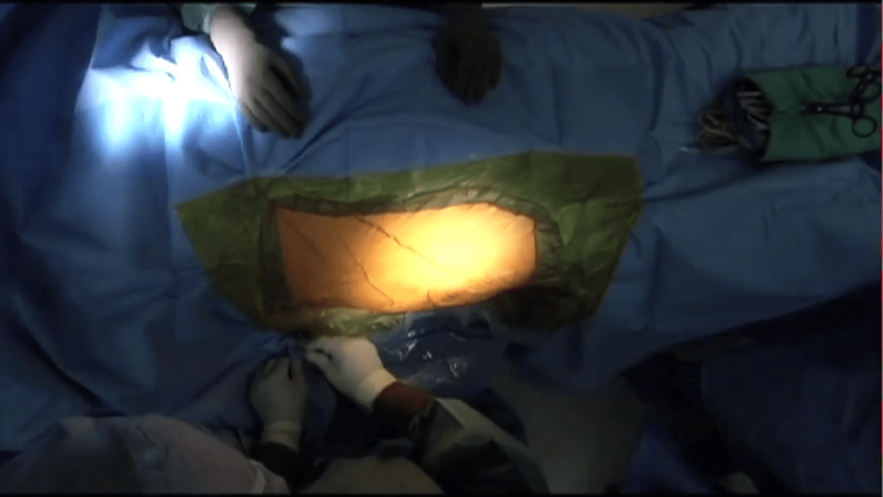 ANTERIOR ADVANTAGE™ Discussion with Joel Matta, MD Draping the Hana