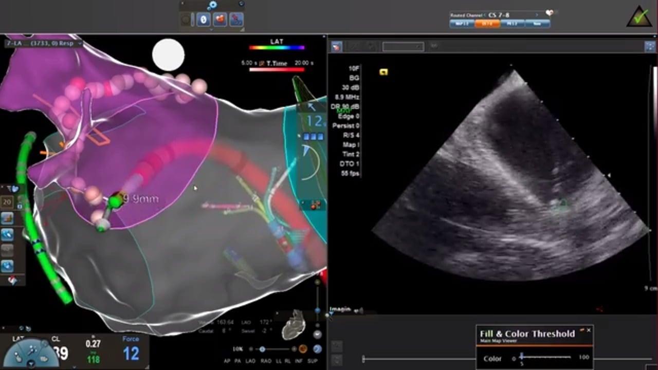 An image from the "Experience with the CARTO VIZIGO™ Sheath" video on the JnJInstitute.com website.
