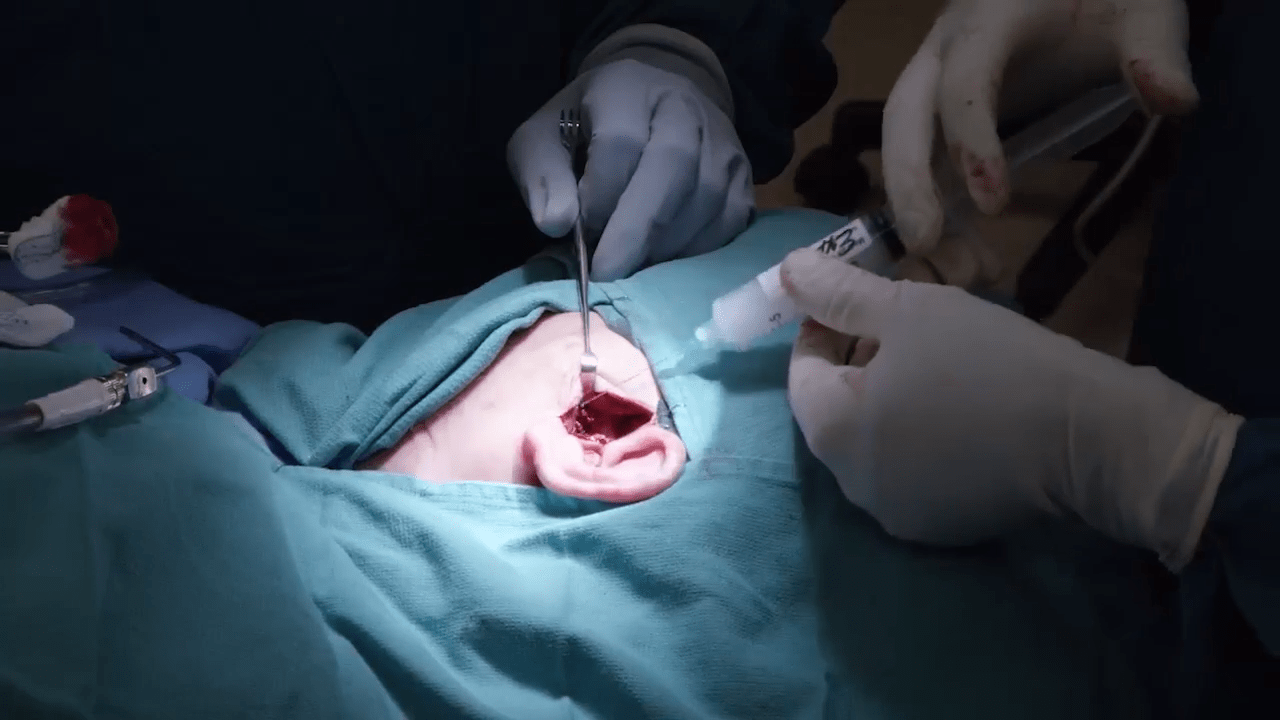 Opioid Minimizing Approach in a Bilateral