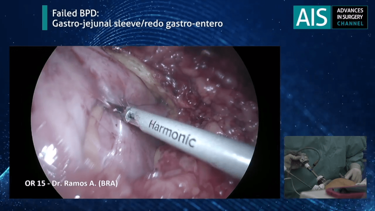 An image from the "Revision Bariatric Surgery - Gastro-Jejunal Sleeve / Redo Gastro-Entero Procedure with Almino Ramos, MD" video on JnJInstitute.com website.