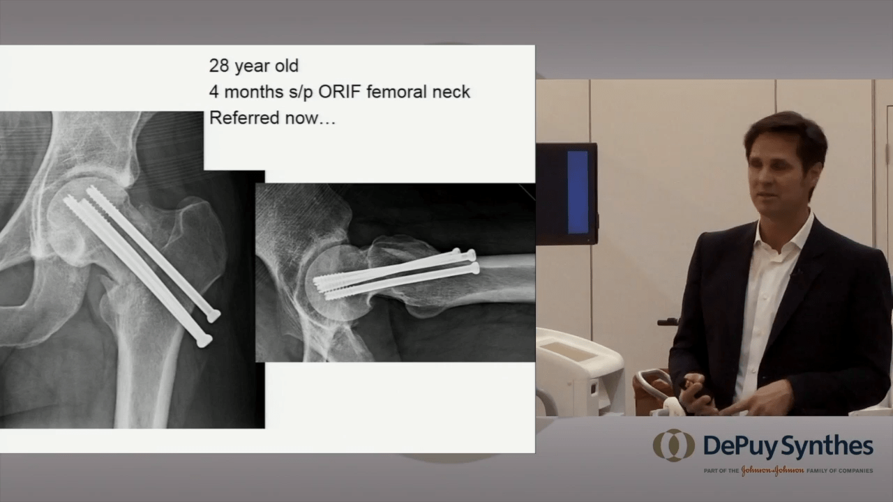 An image from the "Femoral Neck Fracture Treatment Options & Advancements" video on the JnJInsitute.com website.