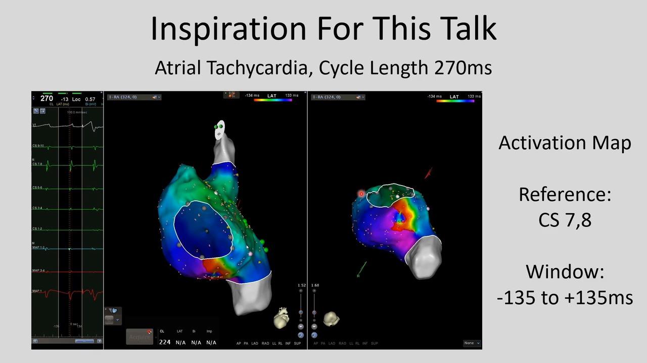 An image from the "Activation Mapping Presentation with Joshua Cooper, MD - Unit 1" playlist on the JnJInstitute.com website.